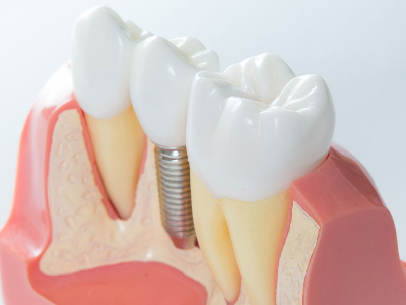 Dental Implants Shoreline