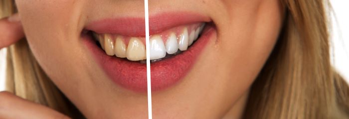 Teeth Whitening Shoreline Dentist